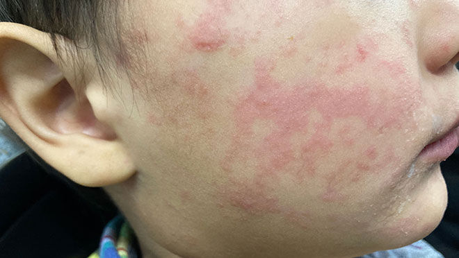 Measles resurgence arrives in Northeast